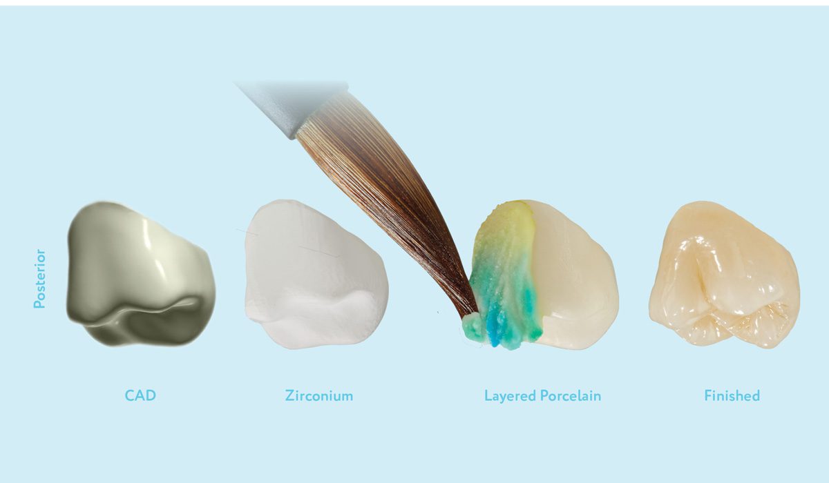 ULTRAflex Partial - Dental Crafters