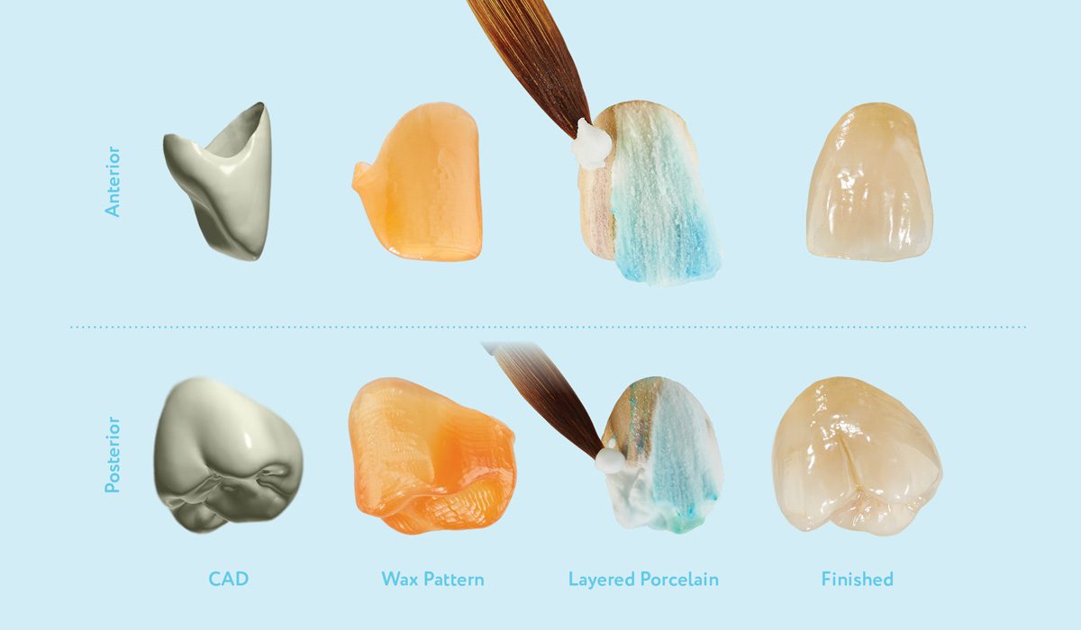 PFM Porcelain — Starcona Dental Supply