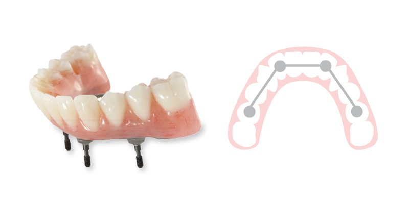 ULTRAflex Partial - Dental Crafters