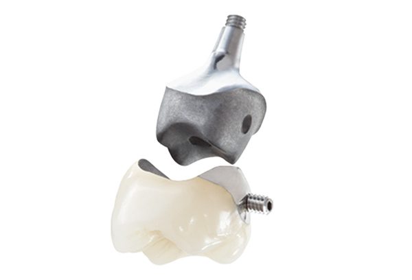 Implant Crowns Screw Lingual