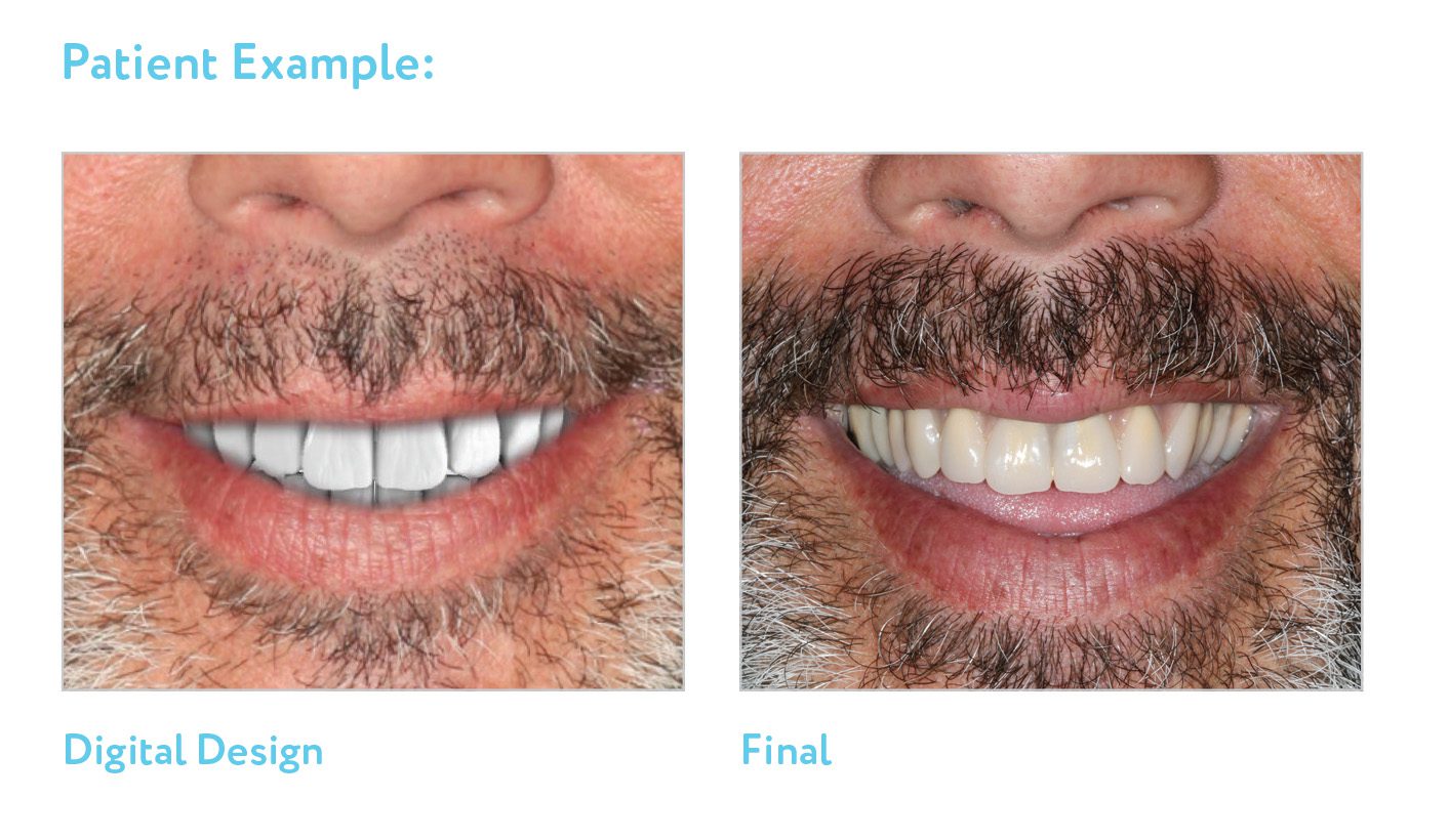 Denture Process Patient Pics from catalog pg. 40_Chuck